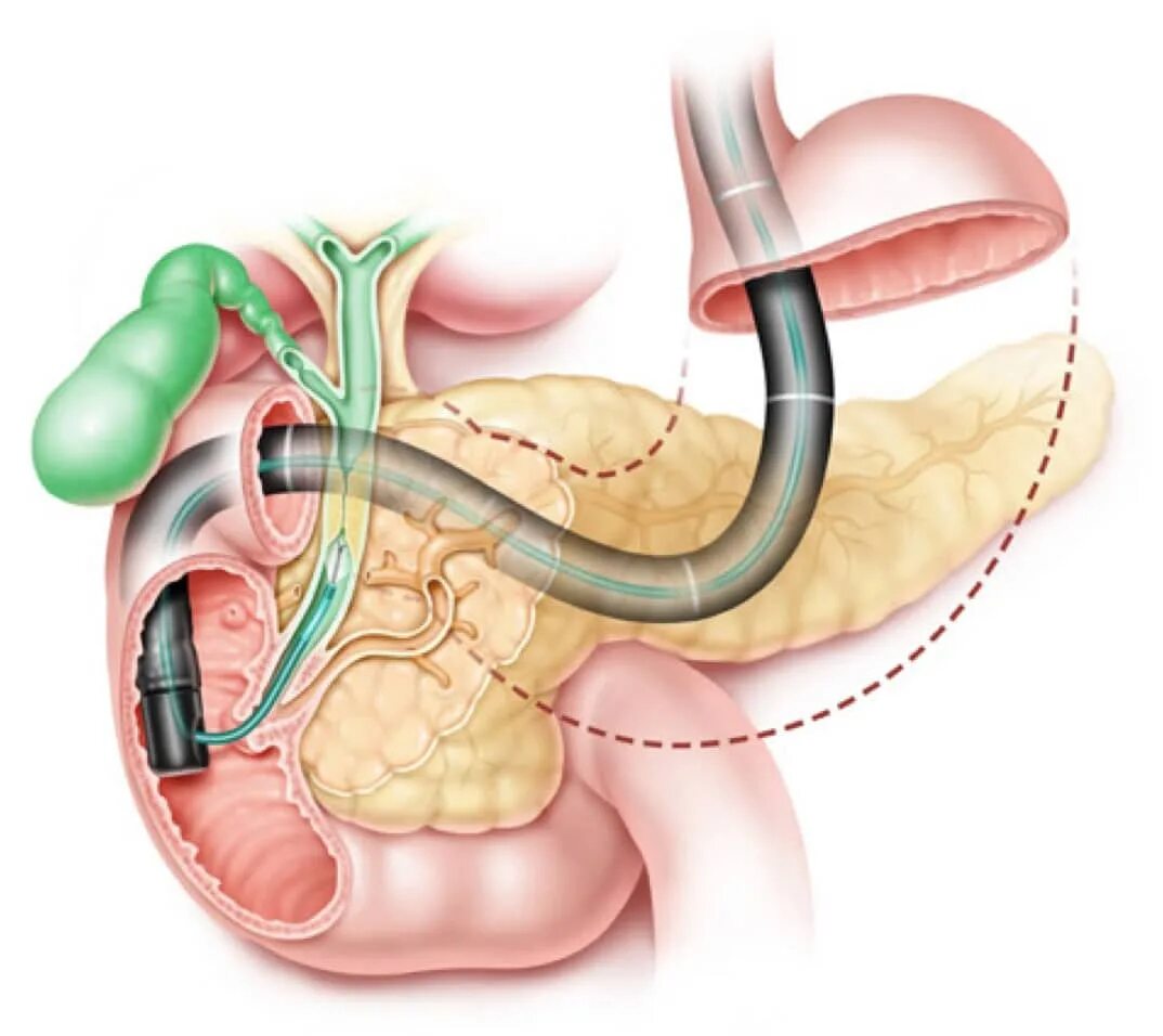 ЭРХПГ поджелудочной железы. Эндоскопическая ретроградная холангиопанкреатография. Ретроградная холангиопанкреатография ЭРХПГ. Эндоскопическая ретроградная холангиопанкреатография (ЭРХПГ). Трубка в желчном пузыре
