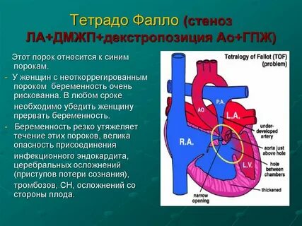 Дмжп у плода