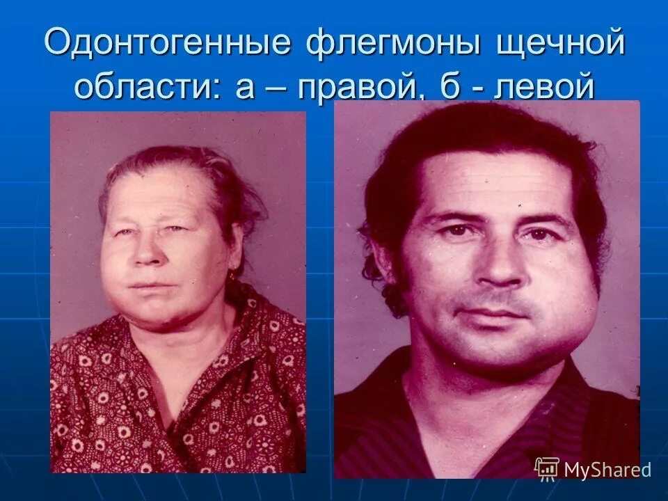 Щечный абсцесс