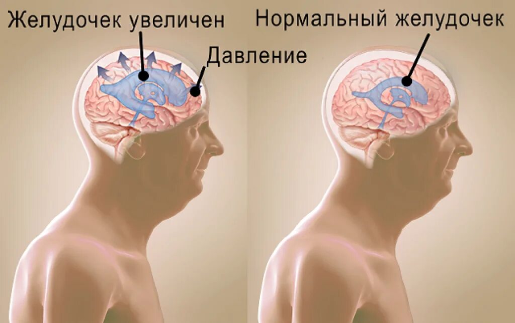 Отек мозга у новорожденных. Гидроцефалия желудочков головного мозга. Водя́нка головно́го мо́зг. Гидроцефалия головного мозга у взрослого. Гидроцефалия симптомы у взрослых.