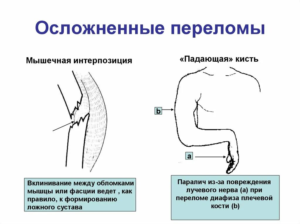 Осложнения при открытых переломах. Повреждения лучевого нерва при переломе плечевой кости со смещением. Осложнения при переломе плечевой кости. Перелом костей плеча осложнения. Осложненные и неосложненные переломы.