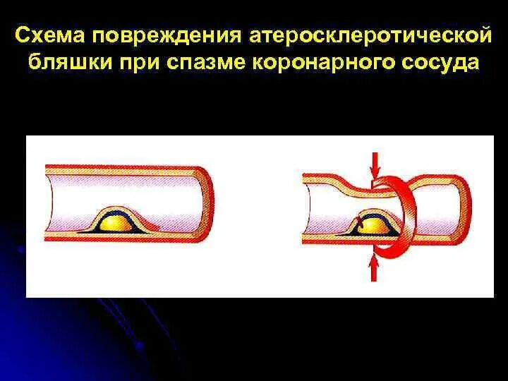 Повреждение сосуда схема. Механическое повреждение сосудов. Сквозное ранение сосуда.