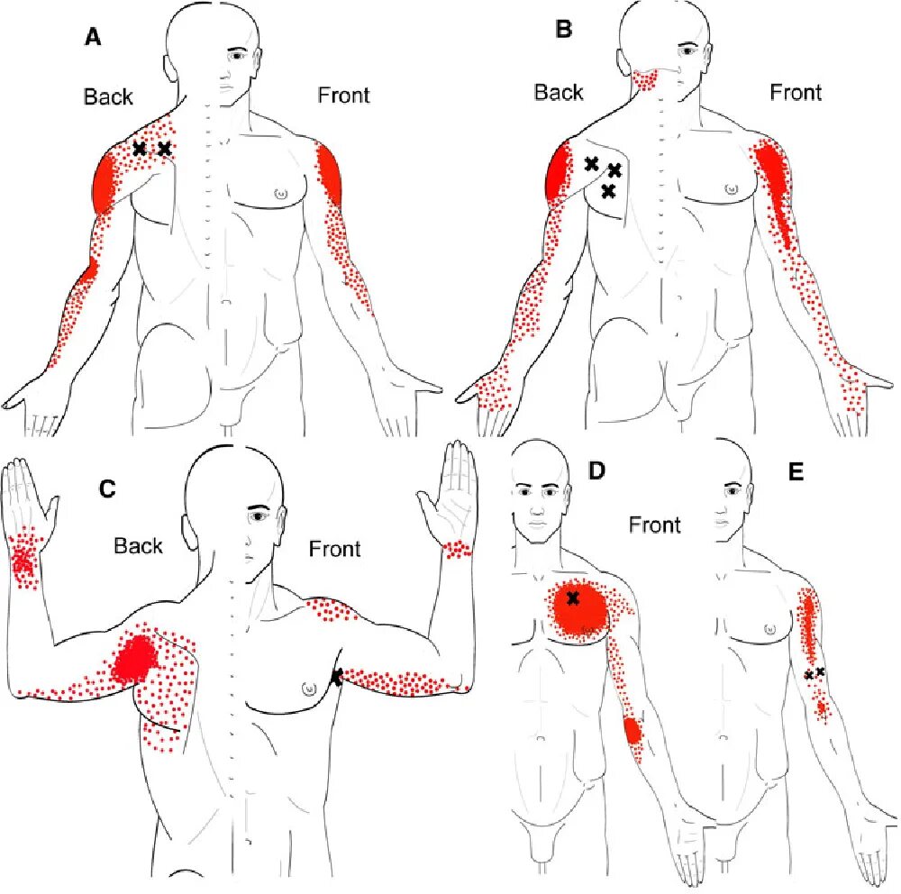 Триггерные точки плеча. Триггерные точки в грудной мышце. Триггерные точки на бицепсе. Карта триггерных точек человека.