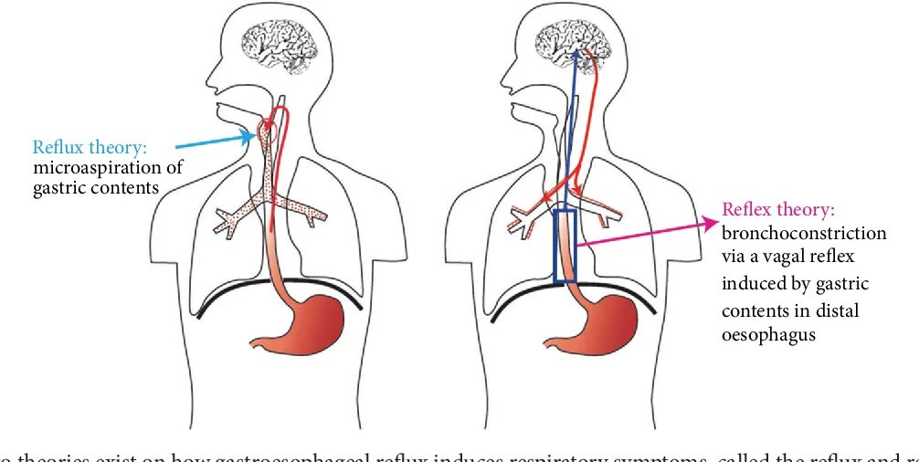 Физиология кашля. Гастроэзофагеальный рефлюкс и кашель. Кашель при рефлюкс. Кашлевой рефлекс. Этапы рефлекторного кашля