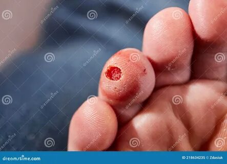 verruca laser treatment - www.z7ya.ru.