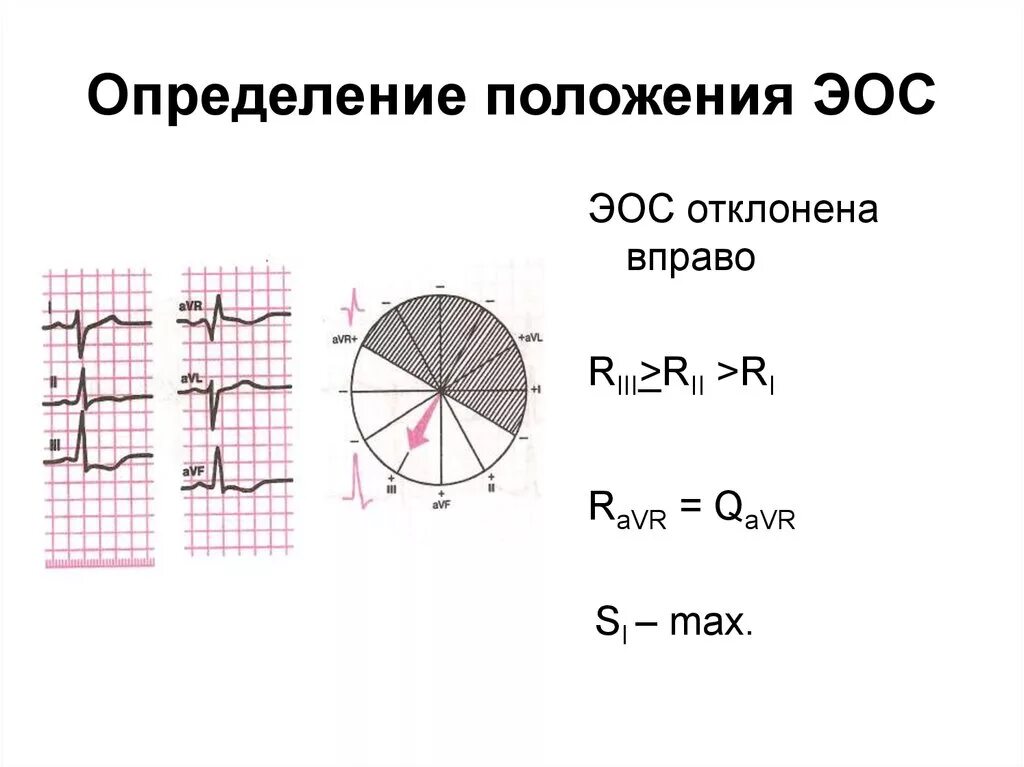 Сердце отклонено вправо. Отклонение электрической оси вправо на ЭКГ. Отклонение электрической оси сердца вправо на ЭКГ. ЭОС отклонение оси. ЭКГ ось отклонена вправо.