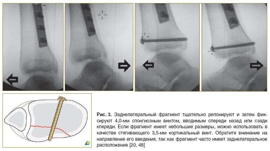 Биос остеосинтез большеберцовой кости. Винтов после операции. Экстрамедуллярный остеосинтез. Остеосинтез шейки бедренной кости канюлированными винтами. Задний спондилодез l5 l6.