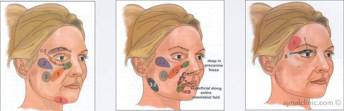 Зоны дояивведения липолитика в лицо. Зоны введения липолитиков на лице. Зона введения липолитика в лицо.