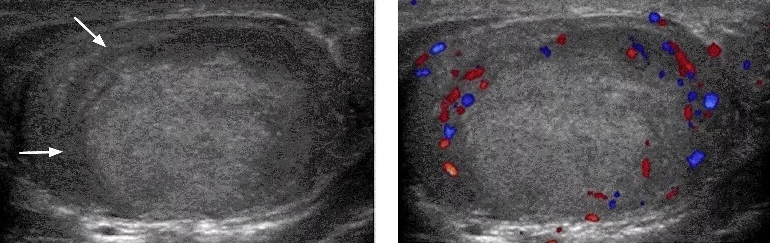 Опухоль яичка семинома. Доброкачественная опухоль яичка УЗИ.