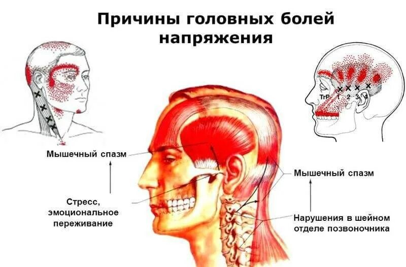 При нагрузке болит голова. Боль напряжения в голове причины. Головная боль напряженного типа. Головная болт ь напряжения. Головная боль напряжения причины.