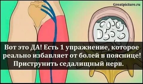 Защемление седалищного при беременности