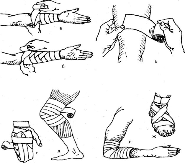 Типы бинтовых повязок на кисть. Перевязки эластичным бинтом алгоритм. Наложение бинтовых повязок. Правило наложения бинтовых повязок. Перевязывать форум