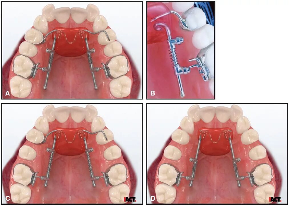 Distal Jet аппарат. Distal Jet ортодонтия. Несъемный аппарат для дистализации distal Jet. Аппарат дистал Джет Американ Ортодонтикс.