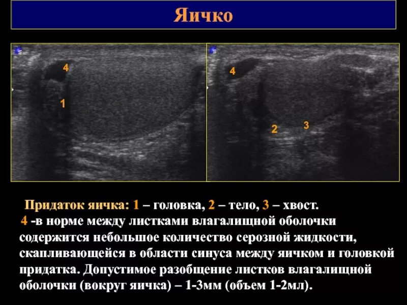 Размеры придатков яичек