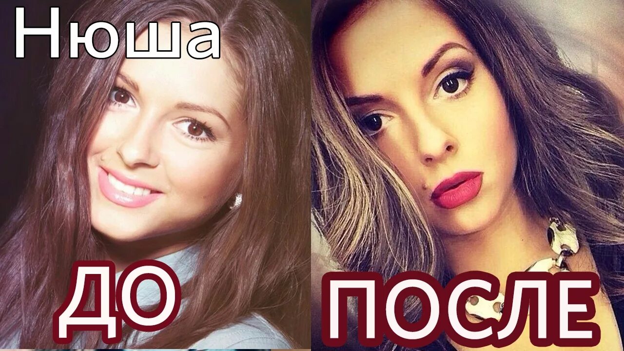 Нюша губы до и после. Нюша губы. нюша с накаченными губами. внешность нюши. нюша переделала лицо.