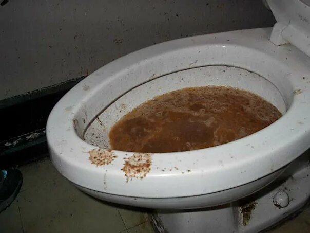 Форма кала при онкологии кишечника. Цвет кала у взрослого. Цвет кала у взрослого. Виды кала у человека. Форма кала.