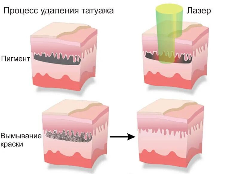 В собственно коже отсутствует пигмент. Глубина введения пигмента в кожу. Лазерное удаление тату. Как удаляют тату лазером.
