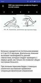 Лфк при переломе