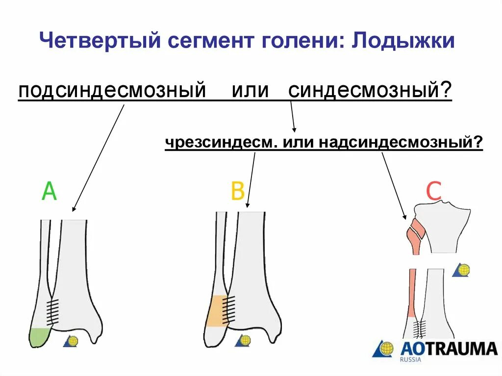 Четвертый сегмент. Ао классификация переломов голени. классификация ао лодыжки. классификация переломов дистального сегмента костей голени. классификация переломов лодыжек по aoasif.