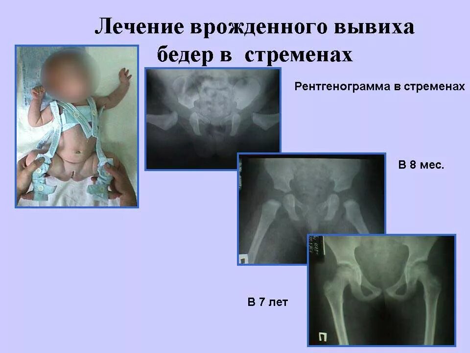 Дисплазия сустава у новорожденного лечение