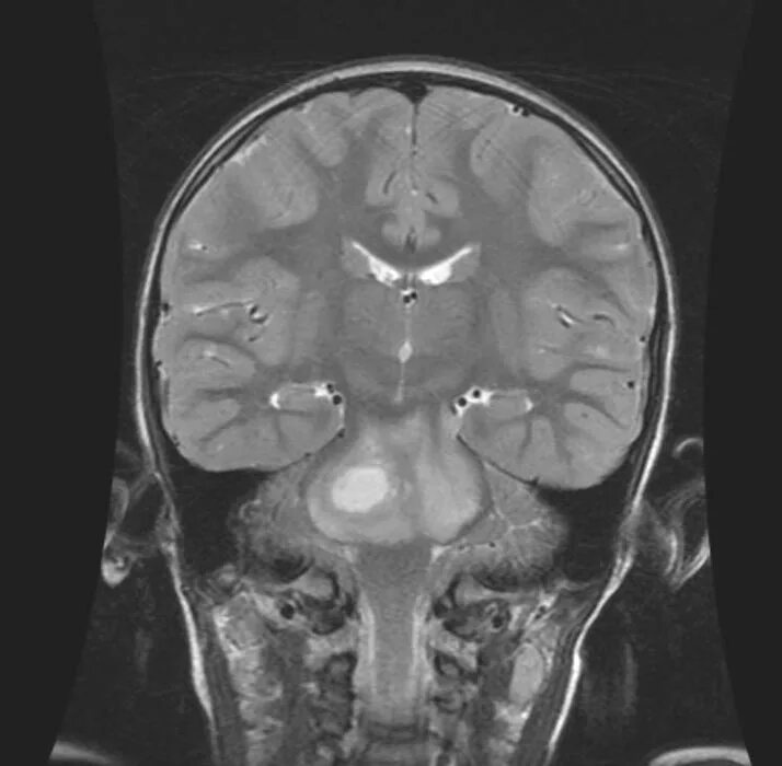Глиома у детей. Диффузная глиома моста. Глиома зрительного нерва.