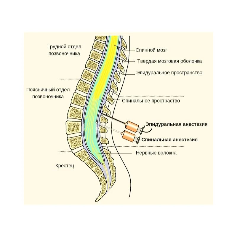 Эпидуральное пространство спинного мозга. Эпидуральная анестезия катетер. Спинальная и эпидуральная анестезия. Эпидуральная анестезия игла.
