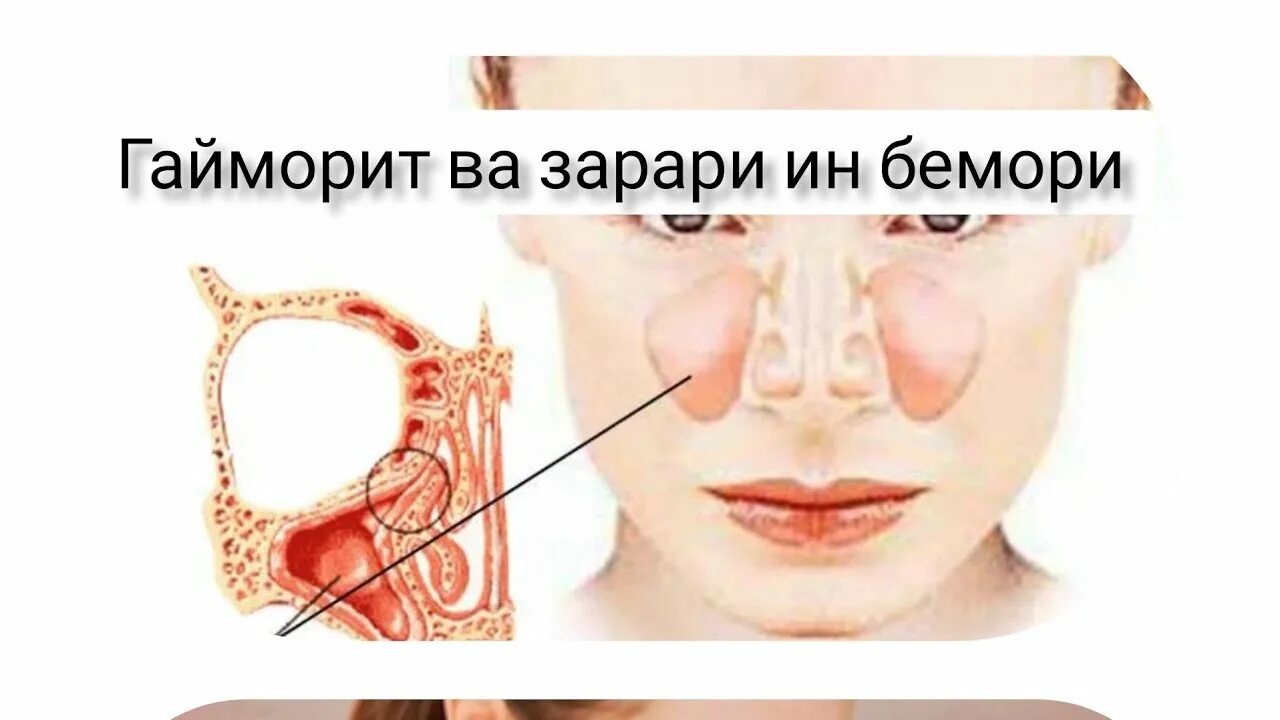 Область гайморовой пазухи. Верхнечелюстная гайморова пазуха. актиномикоз верхнечелюстной пазухи. воспаление гайморовых пазух. гайморит - воспаление слизистой оболочки верхнечелюстной пазухи;.