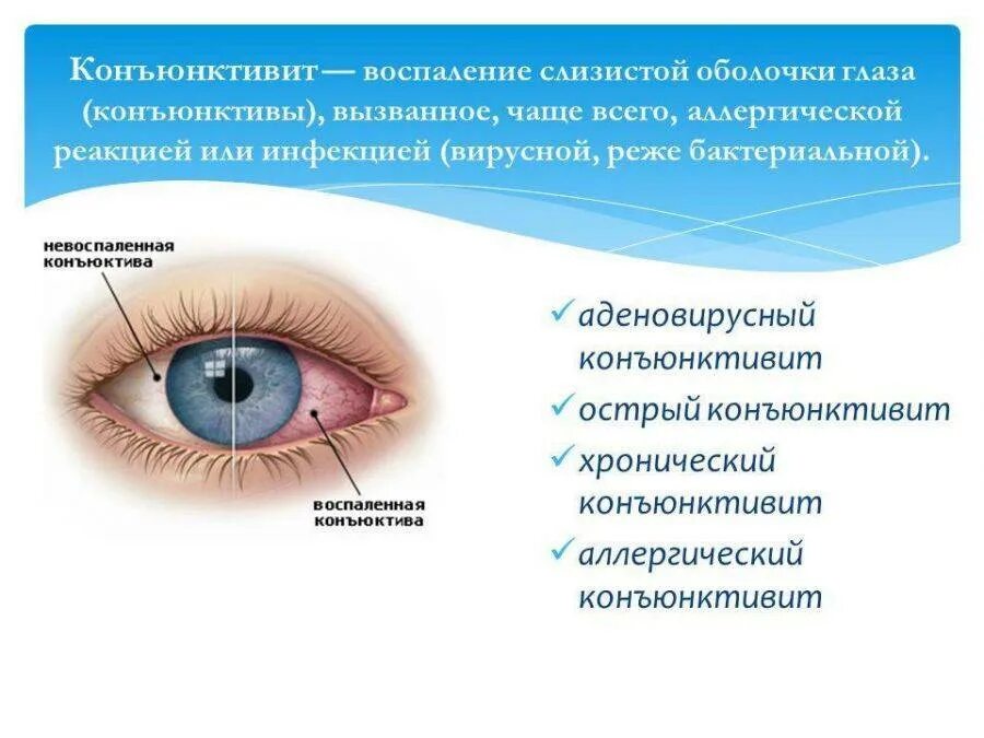 Коньюктивит века. Заболевания зрения конъюнктивит. Глазной конъюнктивит бактериальный. Конъюнктивит и слезятся глаза. Воспаление глаза конъюнктивит у детей.