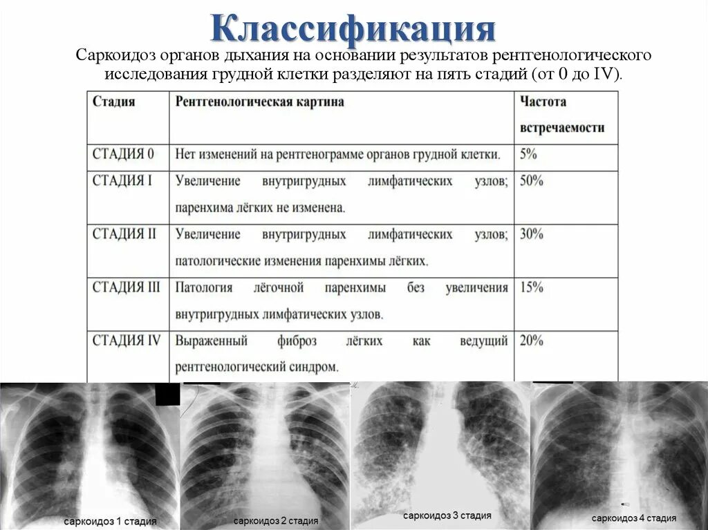 Изменение легкие степени. Саркоидоз легких 4 стадия. Саркоидоз Бека легких рентген. Саркоидоз 3 стадия рентген. Саркоидоз внутригрудных лимфатических узлов рентген.