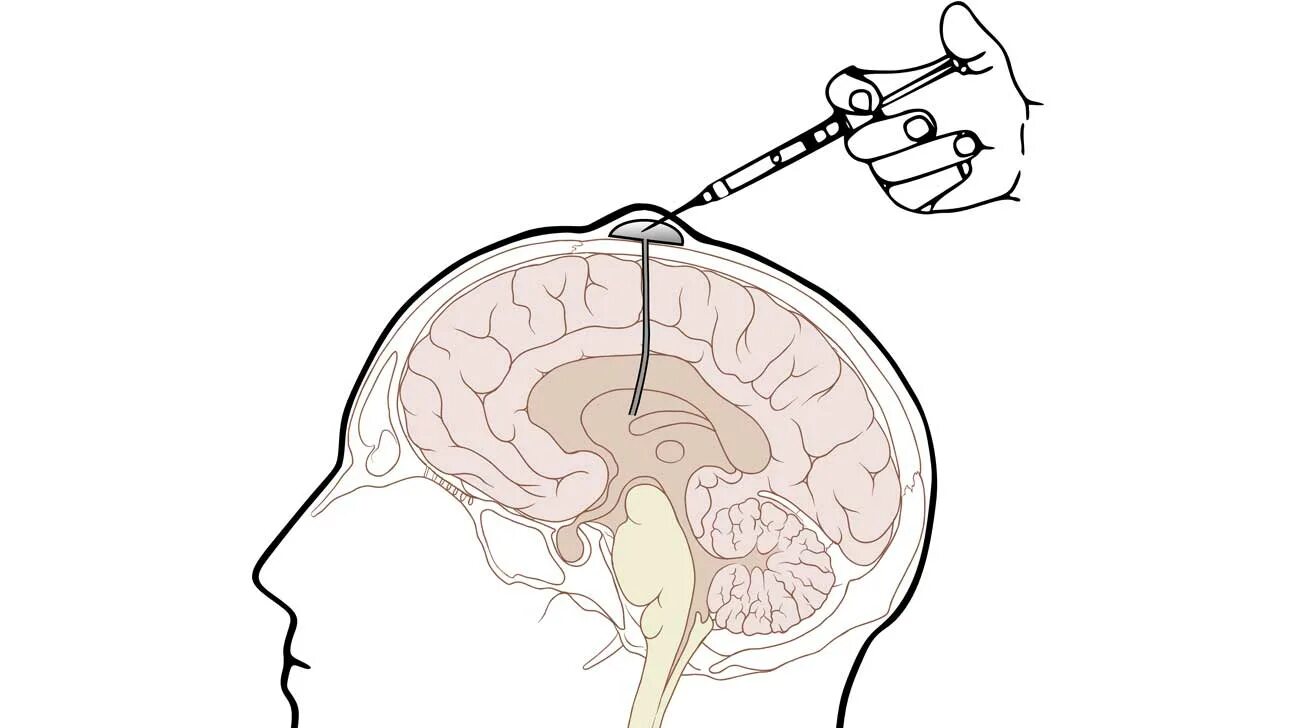 Как делают пункцию мозга