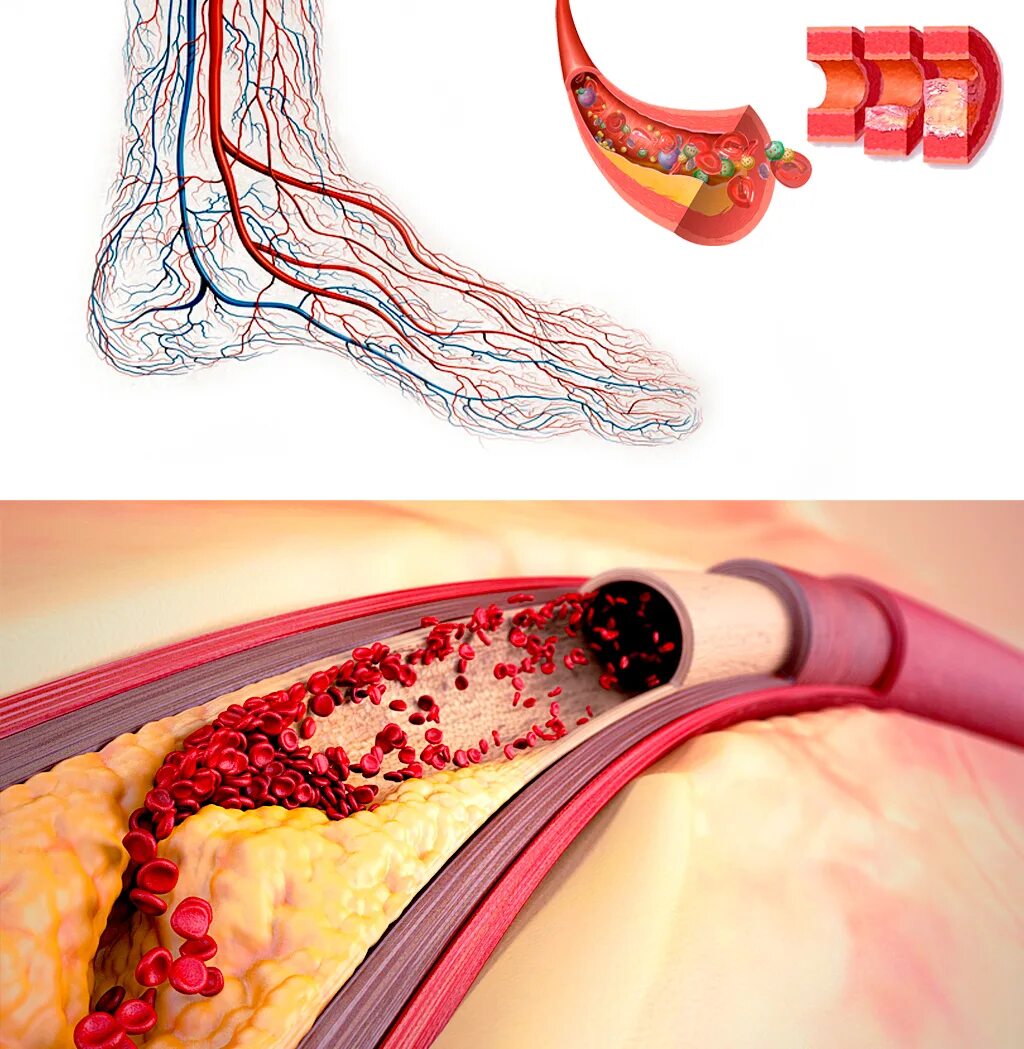 Кровообращение нормализация. Менкеберга атеросклероз. Диабетическая макроангиопатия атеросклероз. Атеросклеротическое поражение кровеносных сосудов.