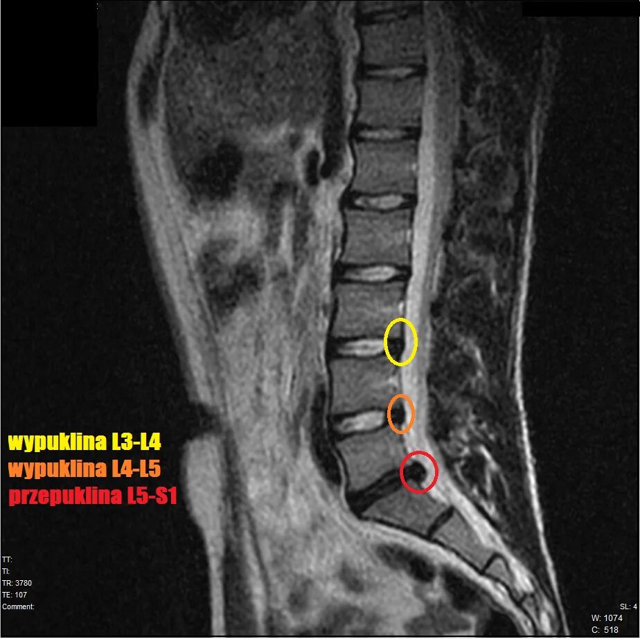 3 4 5 межпозвоночного диска. Диски l5-s1 в позвоночнике. Диски l4 s1 позвоночника. Диски позвонков l3-l4, l4-l5, l5-s1. Протрузия диска l4-s1.