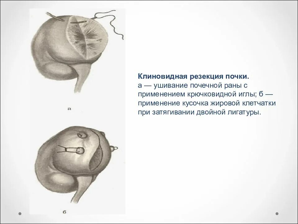 Форум резекции почки. Нефрэктомия, резекция почки швы. клиновидная резекция почки.