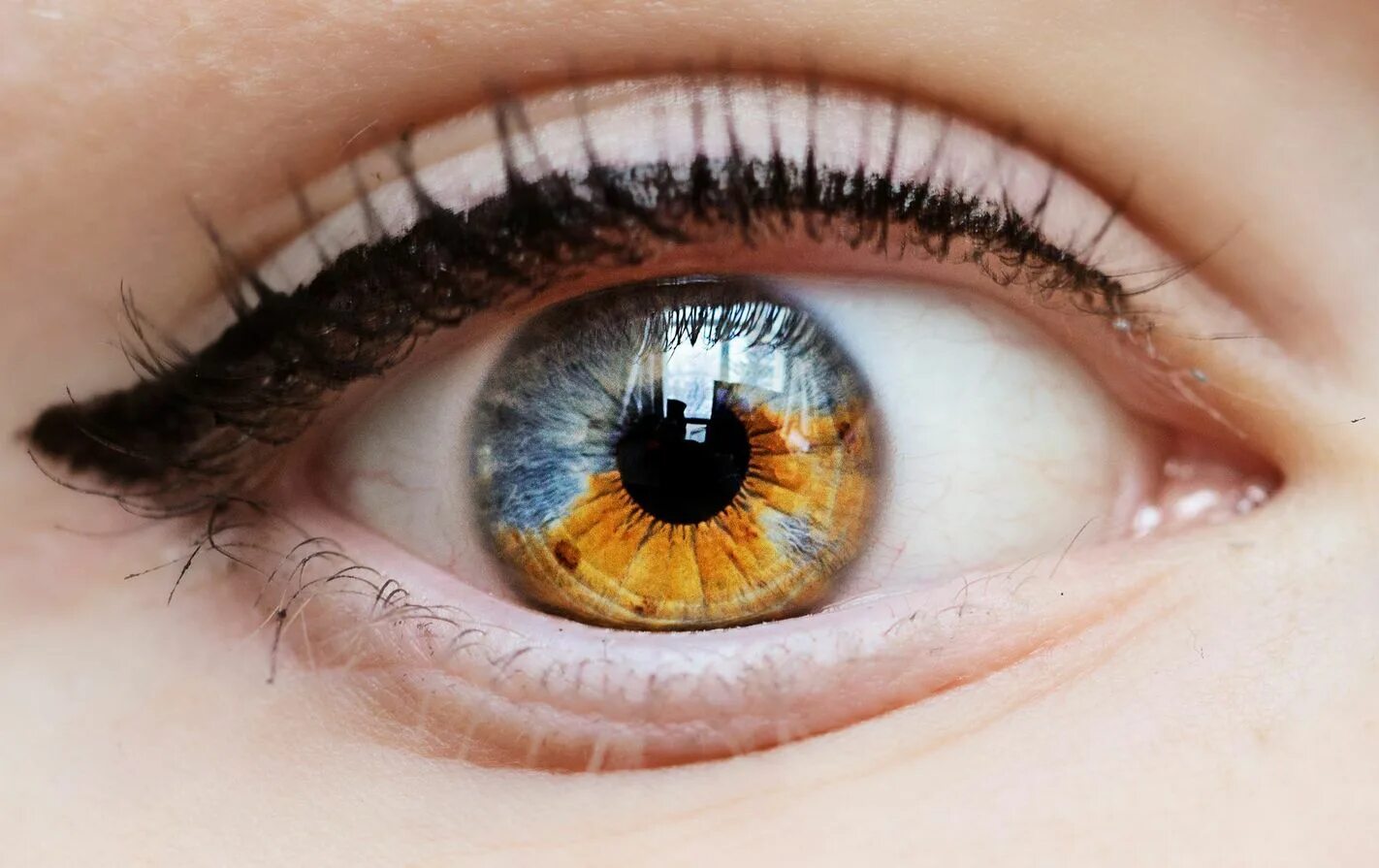 Как называется болезнь когда разный цвет глаз. Металлозная гетерохромия. Частичная гетерохромия карих глаз. Гетерохромия Радужки глаз. Секторная гетерохромия глаза.