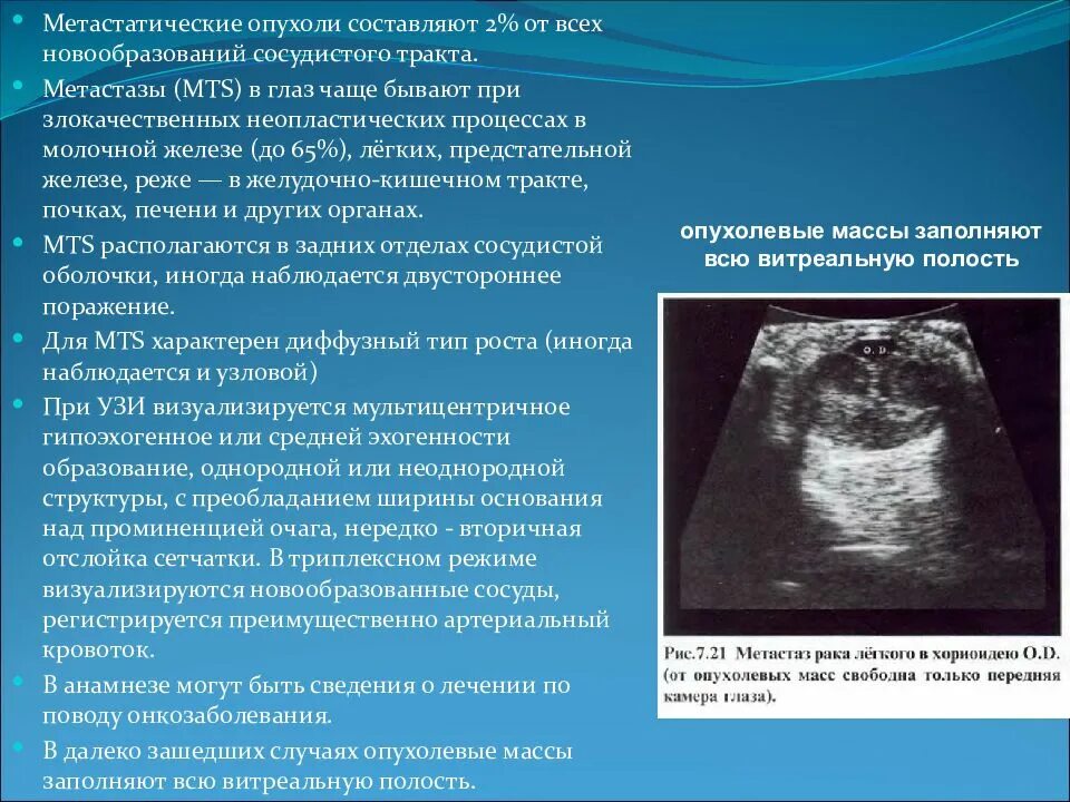 Признаки метастаз при раке. Злокачественная опухоль на УЗИ. Новообразование с неоднородной структурой. Новообразования сосудистого тракта.