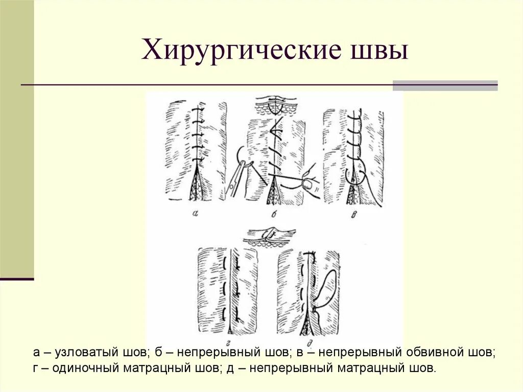 Непрерывные узловые швы в хирургии. Наложение хирургических швов Ветеринария. Непрерывный обвивной шов в хирургии. Обвивной шов в ветеринарии. Как называется шов после операции