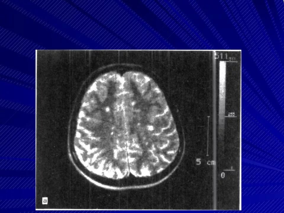 Демиелинизация головного. Очаги демиелинизации при рассеянном склерозе. Очаги демиелинизации головного мозга что это такое. Очаги демиелинизации головного мозга на мрт. Множественные очаги демиелинизации.