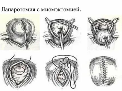 Отзывы после гистерэктомии