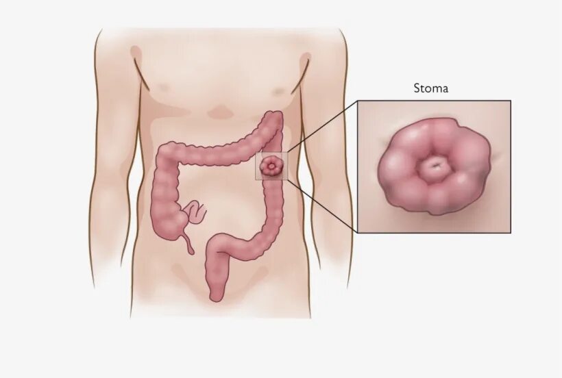 Кохер аппендицит. Илеостома колостома цистостома. Илеостома уростома колостома. Колостома сигмовидной кишки.
