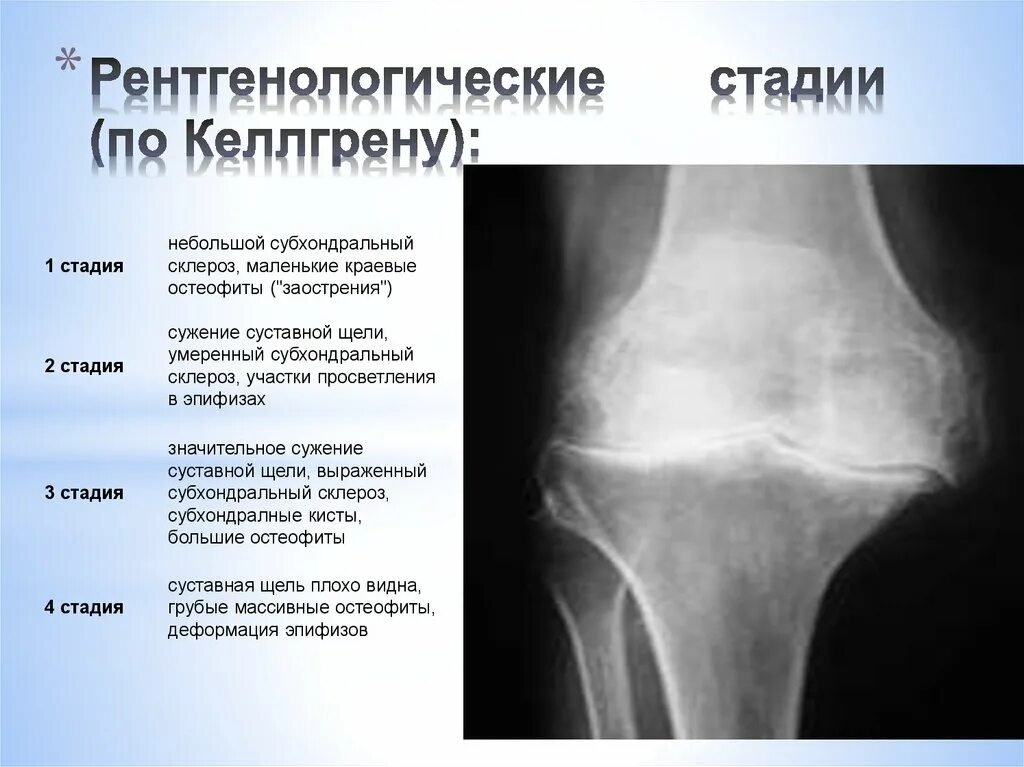 Рентгенологические стадии остеоартроза тазобедренного сустава. Степени артроза коленного сустава на рентгене. Доа тазобедренного сустава 1 степени рентген. Доа коленного сустава рентген описание.