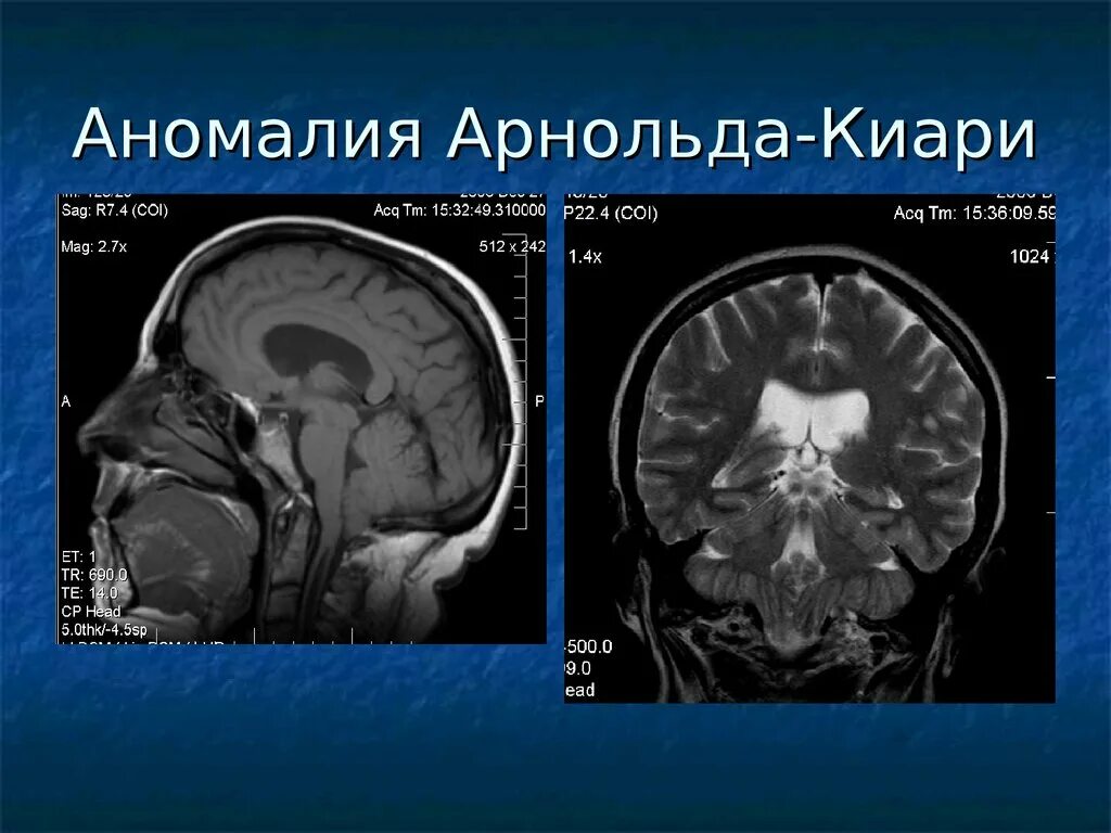 Аномалия 2 степени. Арнольда Киари мрт степени. Аномалия Арнольда Киари 1 типа мрт головного мозга. Аномалия Арнольда Киари мрт. Аномалия Арнольда-Киари 1-2 Тип.