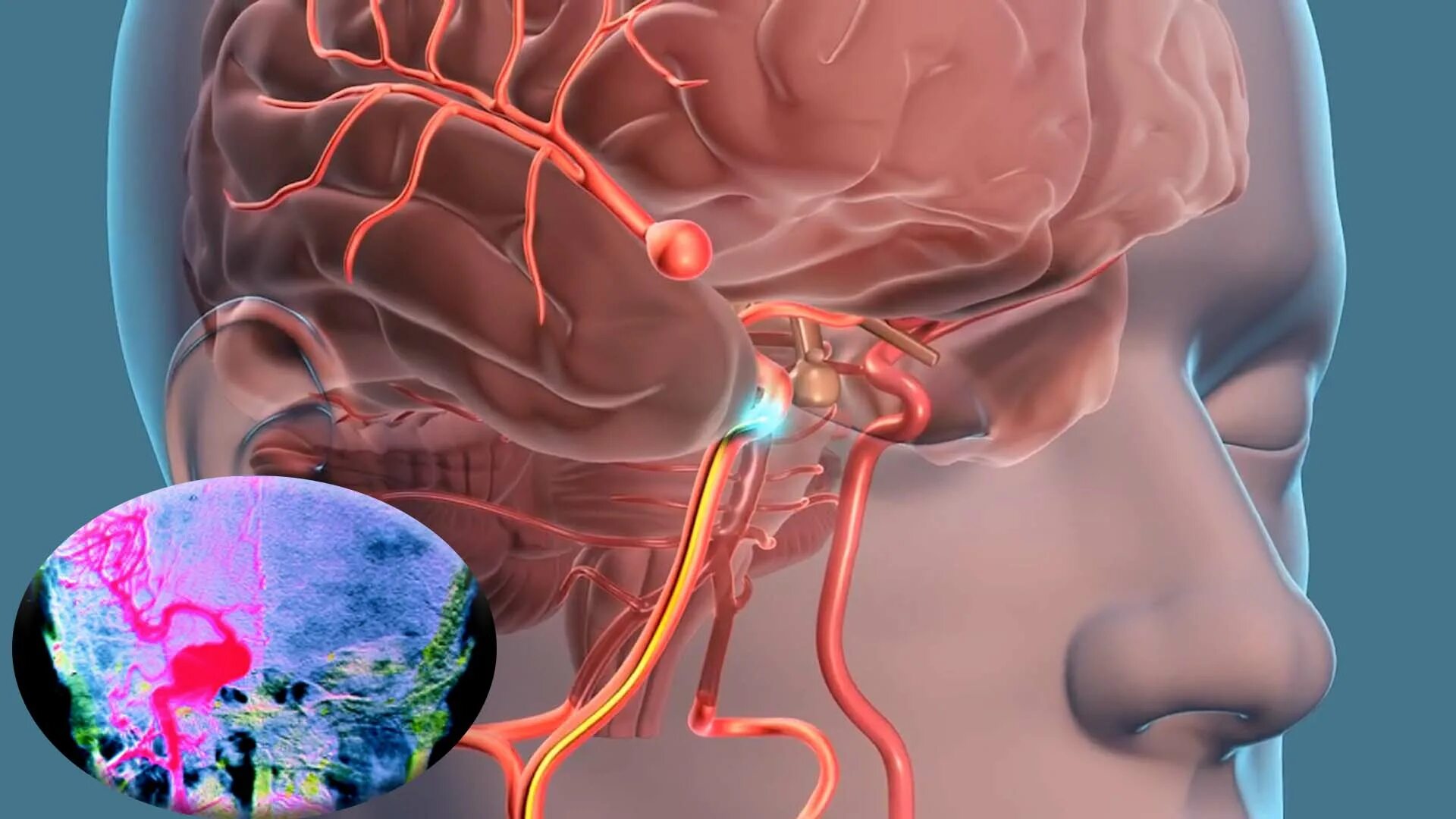 Аневризма сосудов головного мозга. Артериальная аневризма сосудов головного мозга. Аневризма артерии головного мозга. Артериовенозная аневризма сосудов головного мозга. Шум в голове в мозге