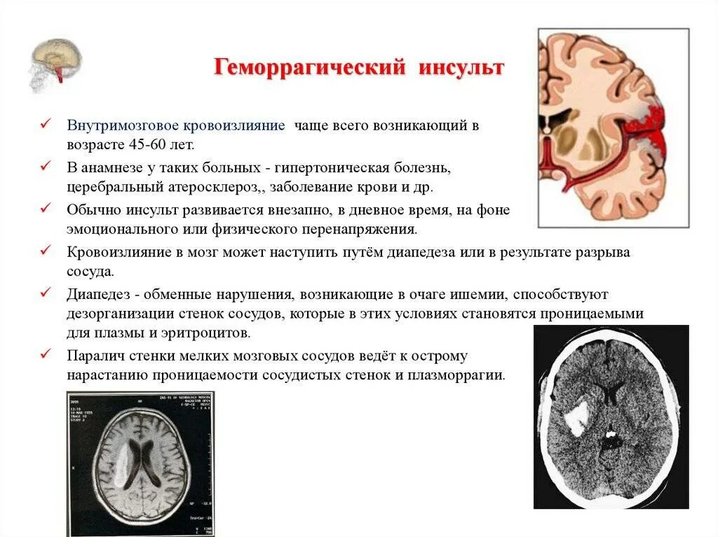 Геморрагический инсульт при гипертонической болезни. Геморрагический инсульт клинический диагноз. Метод исследования геморрагического инсульта. Гемморрагическийиснуль патологоанатомический диагноз.