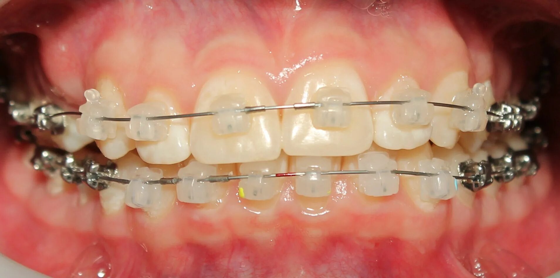 Хирургическая стоматология и ортодонтия. Лингвальные (невидимые) брекеты stb. Невидимые (лингвальные) брекеты. Лингвальная ортодонтия красноярск. Лингвальная ортодонтия красноярск.