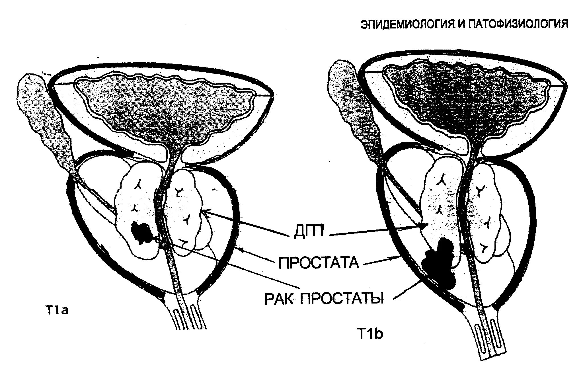 Простата это железа. Карцинома предстательной железы. Лимфоузлы предстательной железы. Регионарные лимфоузлы предстательной железы. Аденома предстательной железы рисунок.