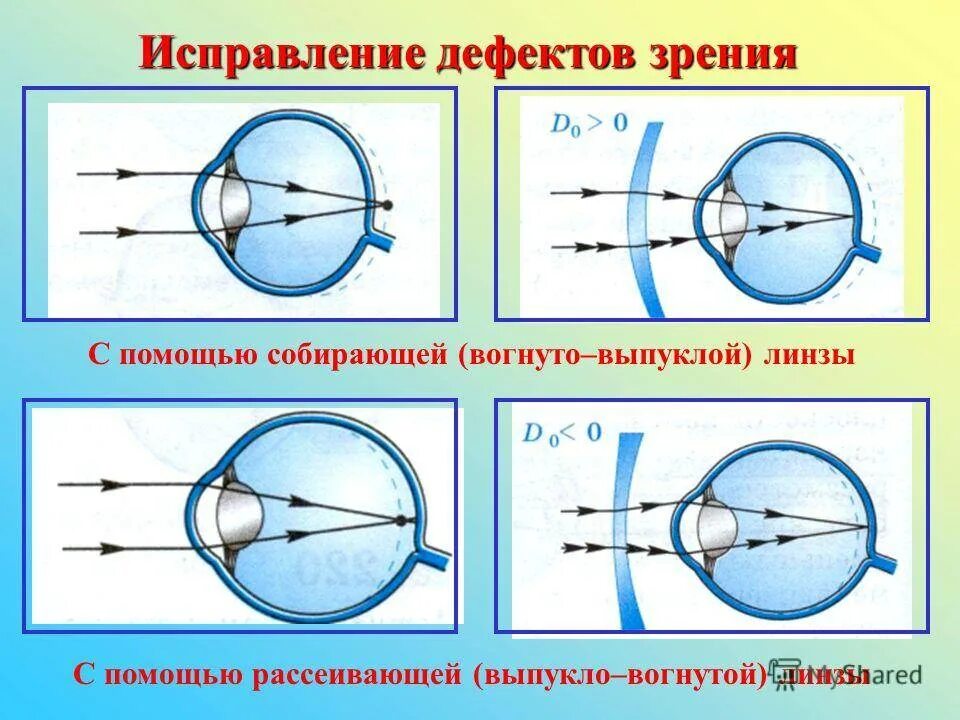 Исправить зрение 1. Дефекты зрения. Дефекты зрения физика. Линзы и дефекты зрения. Строение глаза дефекты зрения.