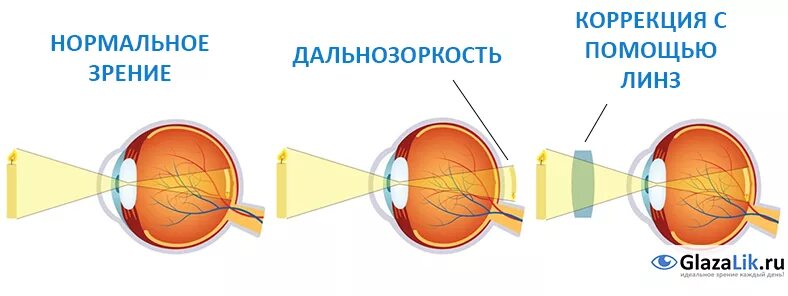 Коррекция зрения с помощью линз. Дальнозоркость 3 степени. Дефекты зрения близорукость и дальнозоркость. Дефекты зрения дальнозоркость физика. Дальнозоркость схема глаза.