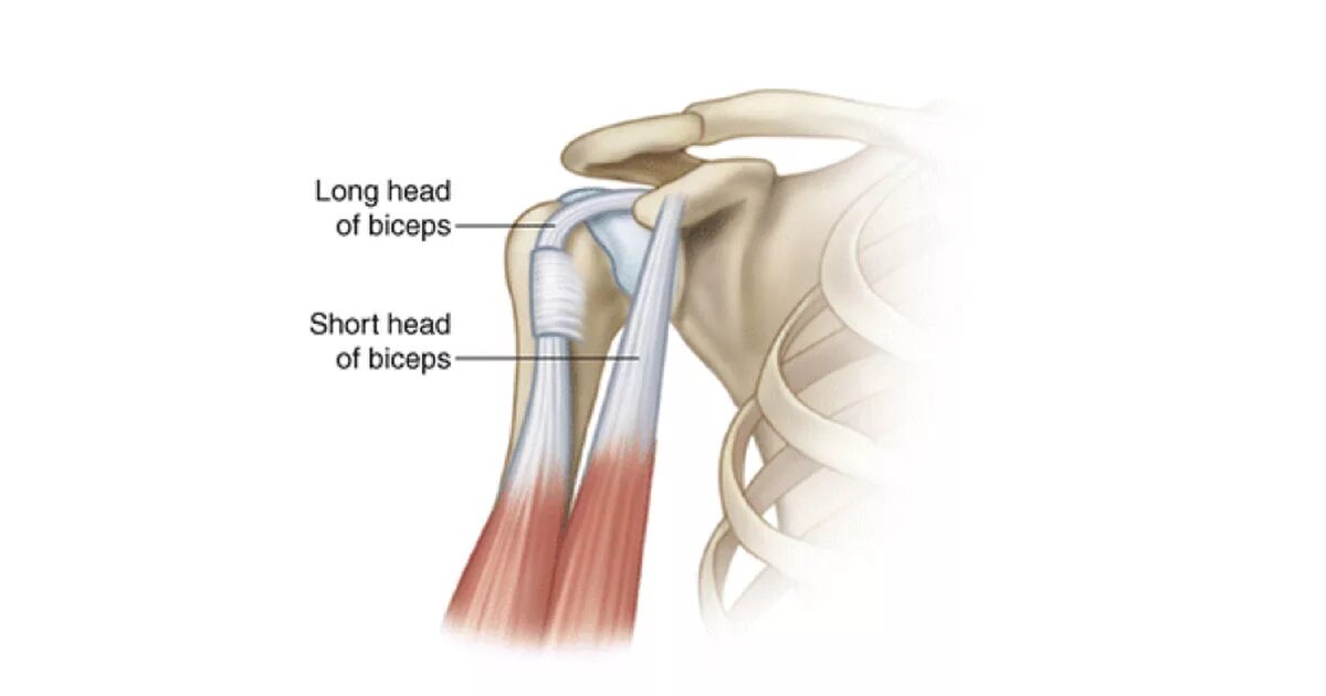 Long head biceps. Тендинит сухожилия длинной головки. Тендинит двуглавой мышцы.