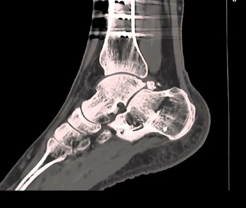 Кт голеностопного сустава. МСКТ голеностопного сустава. Синовит голеностопного сустава кт. Импрессионный перелом голеностопного сустава кт.