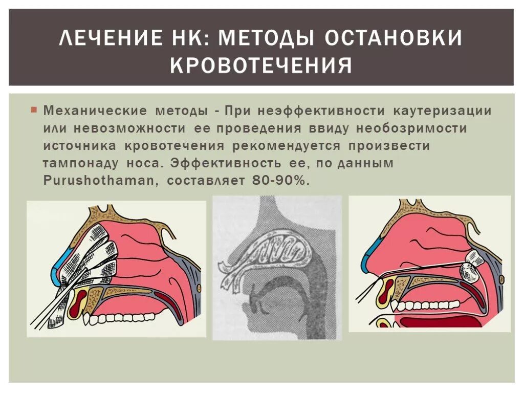 Носовое кровотечение является. Носовые кровотечения остановка кровотечения. Метод остановки носового кровотечения. Остановка носовго кровотечени. Метод остановки кровотечения из носа.